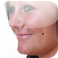 Cheek piercinger