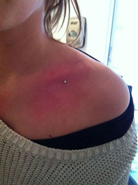 Dermal fra PiercingHuset.dk
