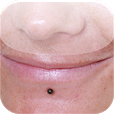 Lower labret