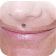 Medusa piercing